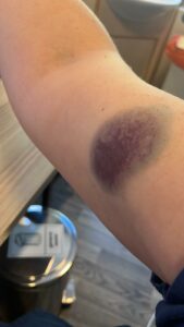 bruises on an arm