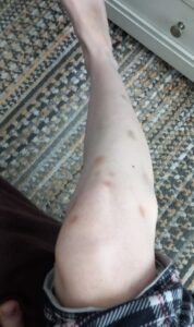 Ash Dean bruises on lower leg